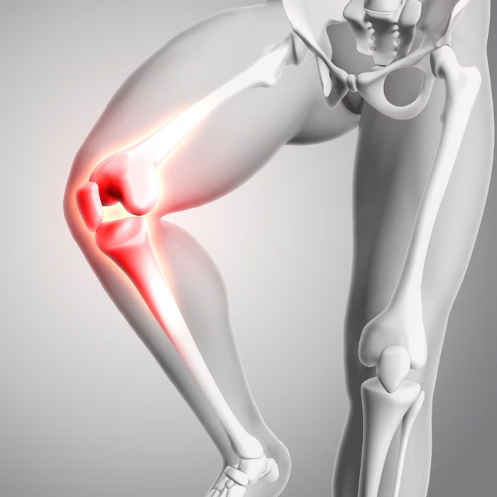 Reemplazo de rodilla